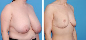 , Breast Reduction – Patient 63