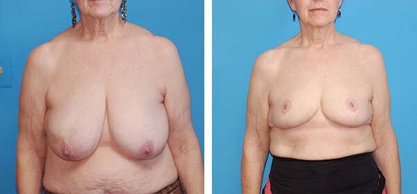 , Breast Reduction &#8211; Patient 64