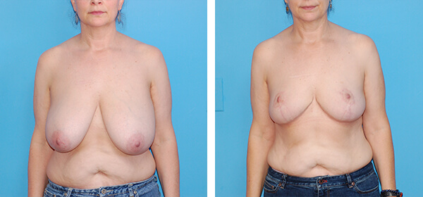 , Breast Reduction &#8211; Patient 65