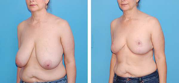 , Breast Reduction – Patient 65
