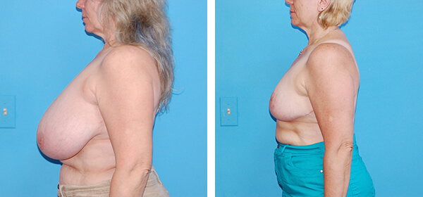 , Breast Reduction – Patient 66