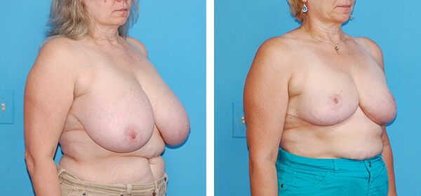 , Breast Reduction – Patient 66