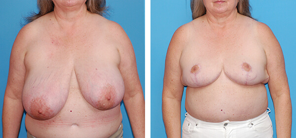 , Breast Reduction – Patient 62
