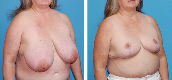 , Breast Reduction – Patient 62