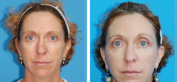 , Eyebrow Lift &#8211; Patient 5