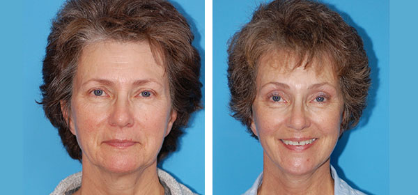 , Eyebrow Lift &#8211; Patient 454301