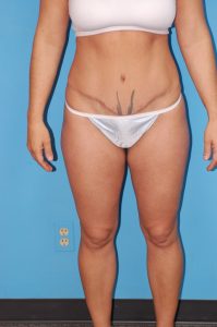 , Tummy Tuck Before and After Pictures