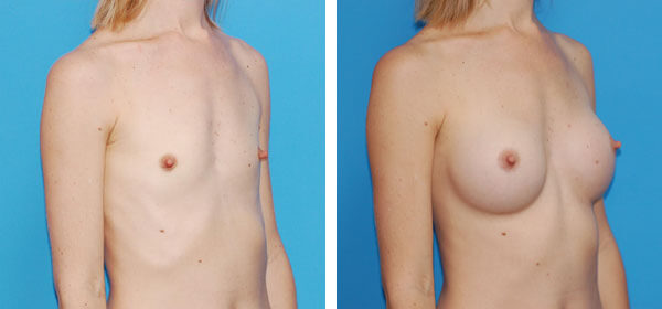 , Breast Augmentation – Patient 2