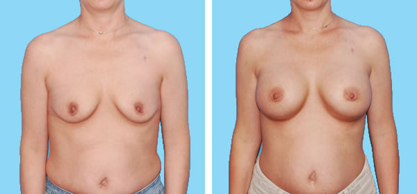 , Breast Augmentation – Patient 9