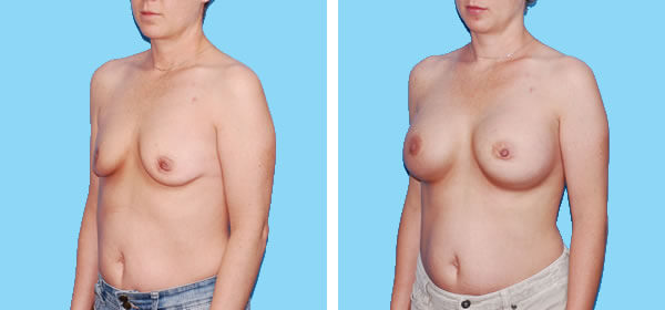 , Breast Augmentation – Patient 9