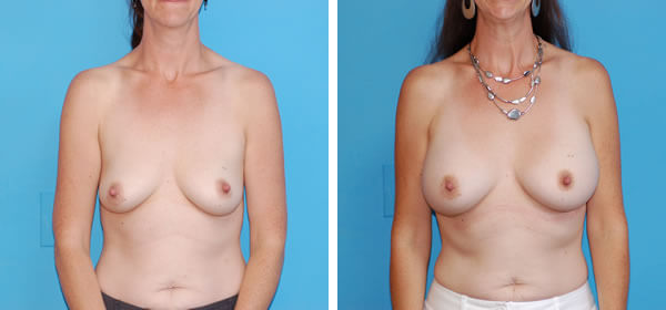 , Breast Augmentation &#8211; Patient 16
