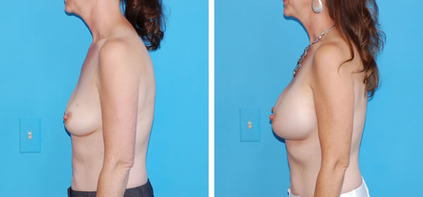 , Breast Augmentation &#8211; Patient 16
