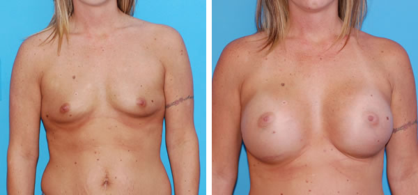 , Breast Augmentation &#8211; Patient 18