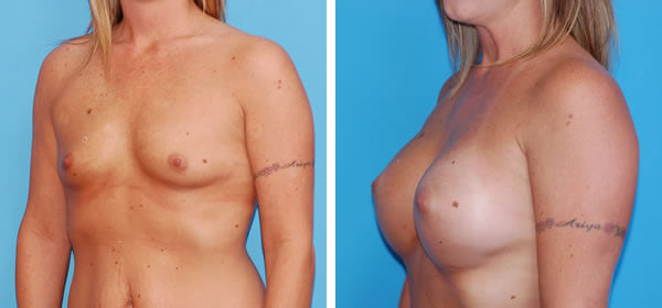 , Breast Augmentation &#8211; Patient 18
