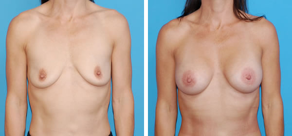 , Breast Augmentation &#8211; Patient 19