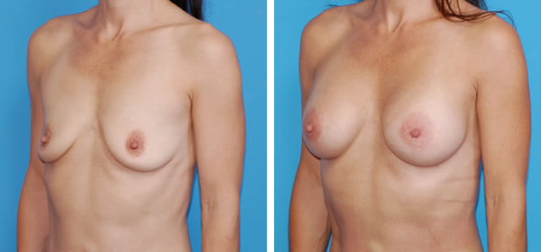 , Breast Augmentation &#8211; Patient 19
