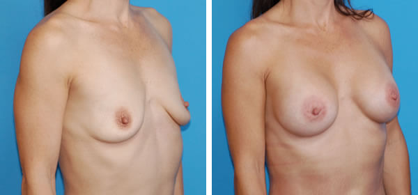 , Breast Augmentation – Patient 19