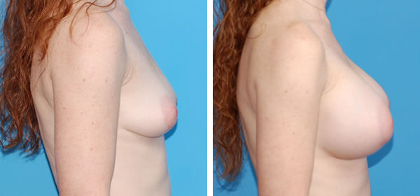 , Breast Augmentation &#8211; Patient 20