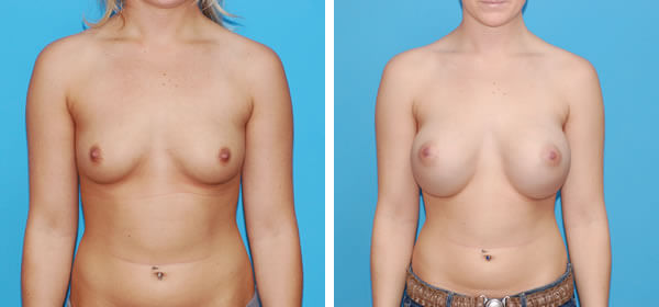 , Breast Augmentation &#8211; Patient 23