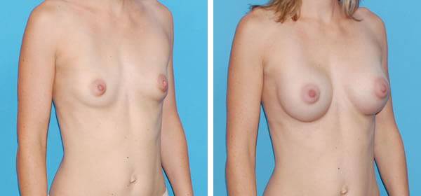 , Breast Augmentation &#8211; Patient 26