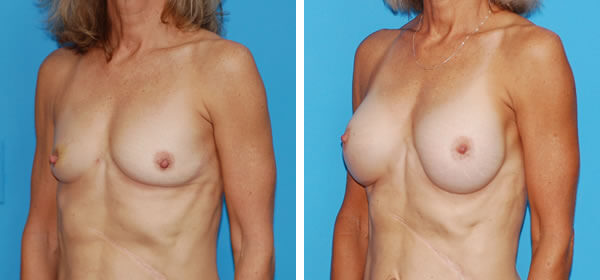 , Breast Augmentation &#8211; Patient 30