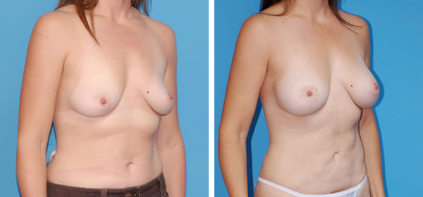 , Breast Augmentation &#8211; Patient 52