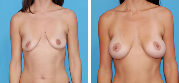 , Breast Augmentation &#8211; Patient 53