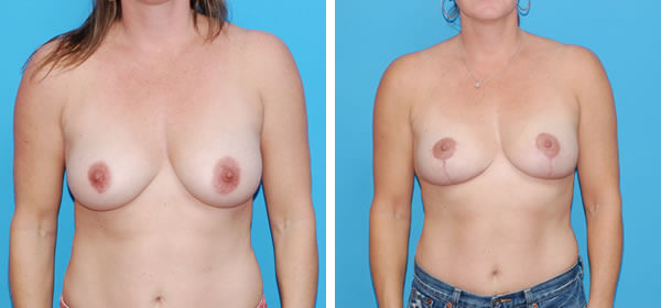 , Breast Lift Photo Gallery
