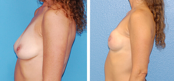 , Breast Reconstruction Patient 2