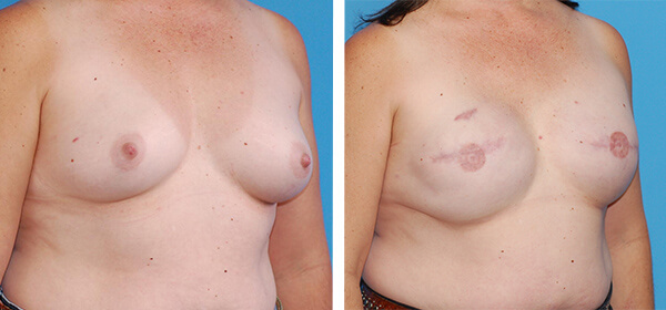 , Breast Reconstruction Patient 1