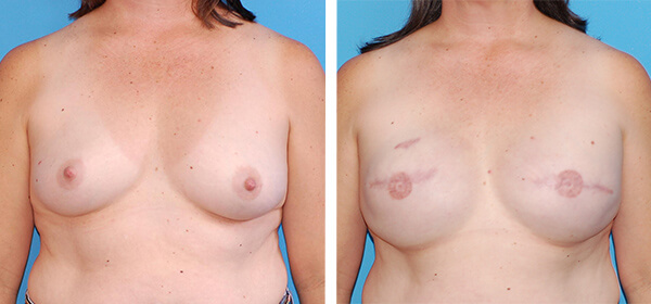 , Breast Reconstruction Patient 1