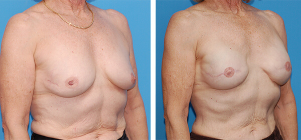 , Breast Reconstruction Patient 3