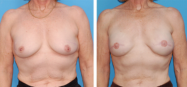 , Breast Reconstruction Patient 3