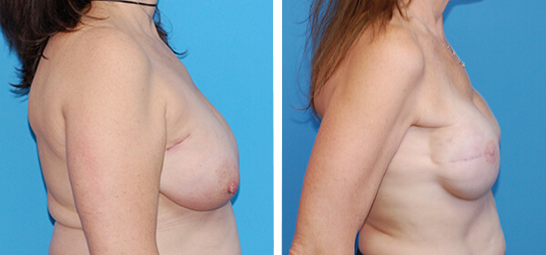 , Breast Reconstruction Patient 4