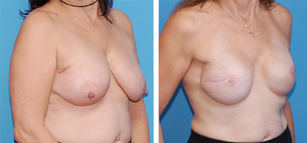 , Breast Reconstruction Patient 4