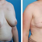 , Breast Reconstruction Patient 5