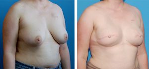 , Breast Reconstruction Patient 5