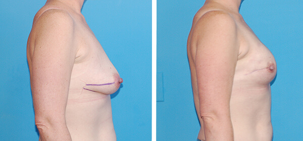 , Breast Reconstruction Patient 6