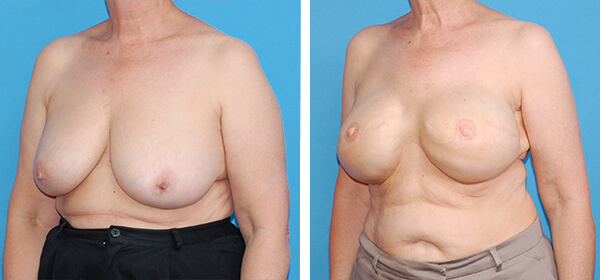 , Breast Reconstruction Patient 7