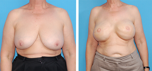 , Breast Reconstruction Patient 7