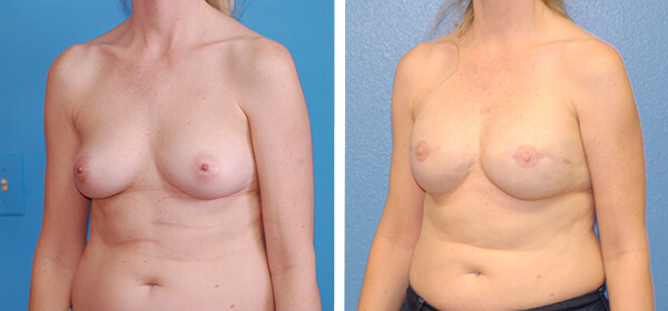 , Breast Reconstruction Patient 8