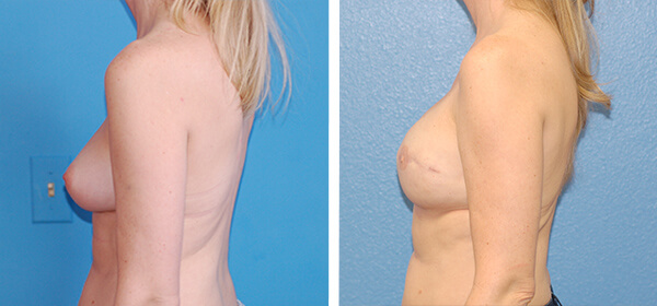 , Breast Reconstruction Patient 8