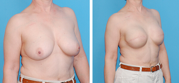 , Breast Reconstruction Patient 9