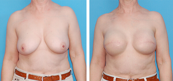 , Breast Reconstruction Patient 9