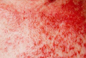 , Skin Cancer Symptoms