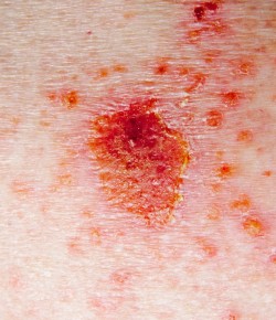 , Skin Cancer Treatment Guide