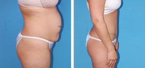 , Liposuction &#8211; Body Contouring