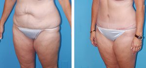 , Liposuction &#8211; Body Contouring