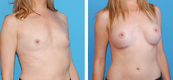 , Breast Augmentation &#8211; Patient 54
