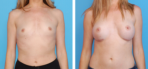 , Breast Augmentation &#8211; Patient 54